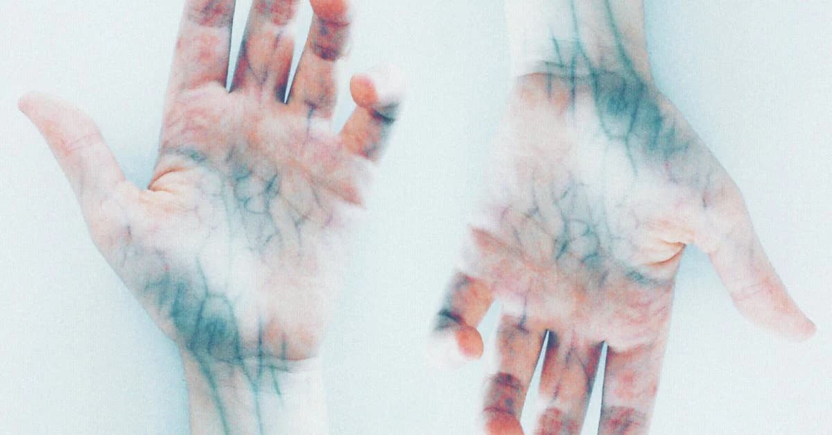 Cover Image for Sclerotherapy Explained: Say Goodbye to Varicose Veins for Good